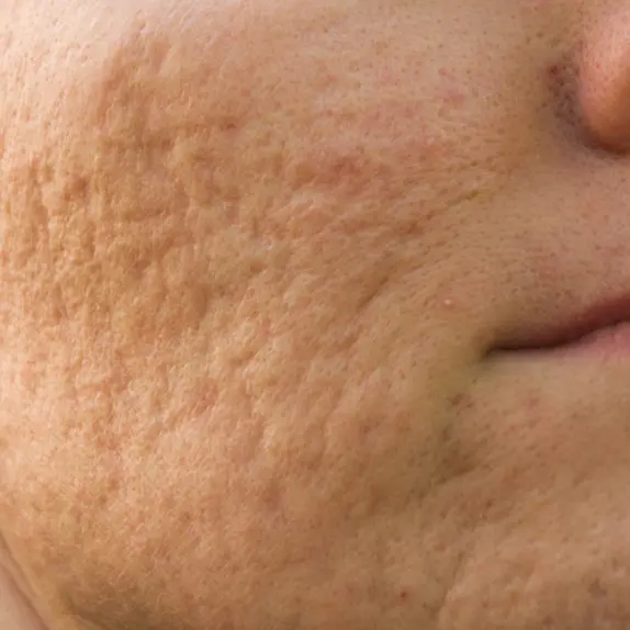 Acne Scarring