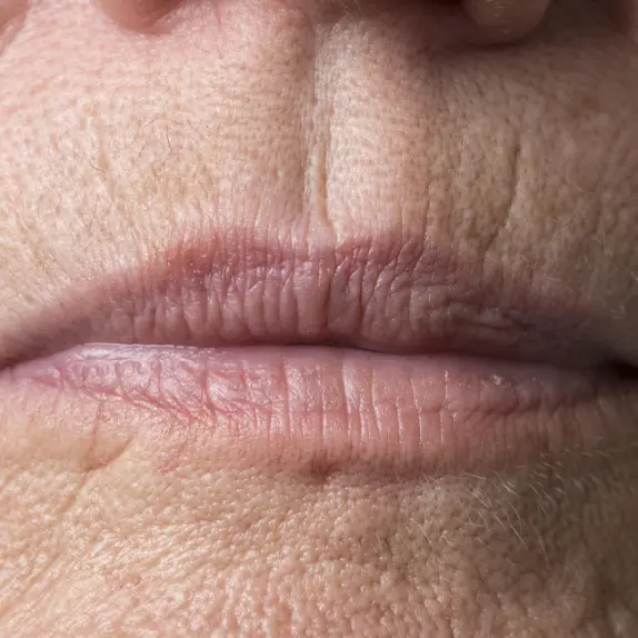 Upper Lip Lines