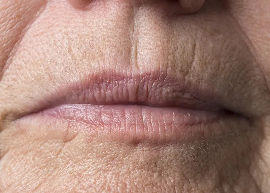 Upper Lip Lines