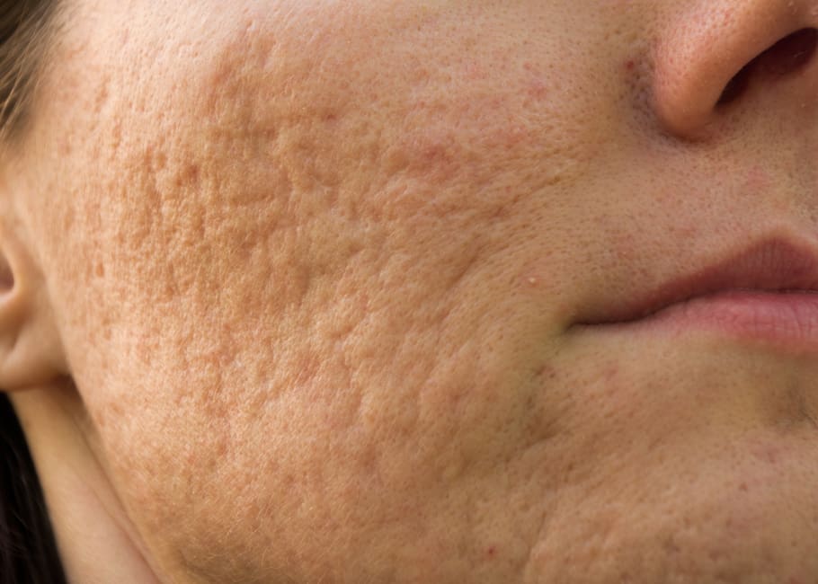 Acne Scarring